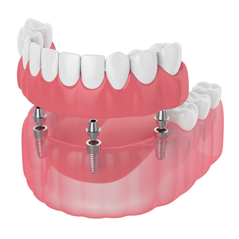 Implant-retained denture in West Bloomfield