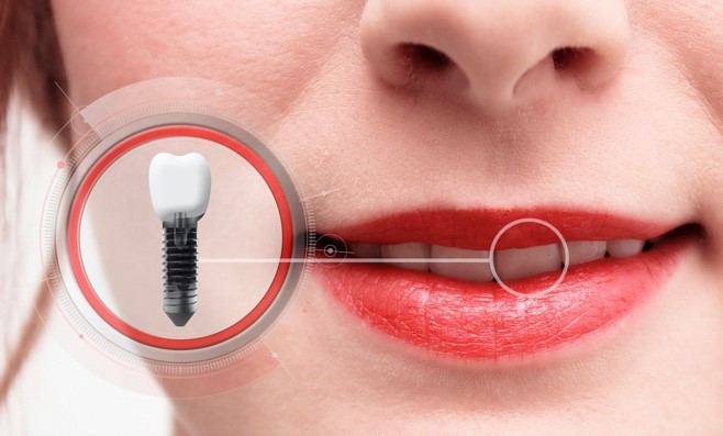 Woman with a dental implant