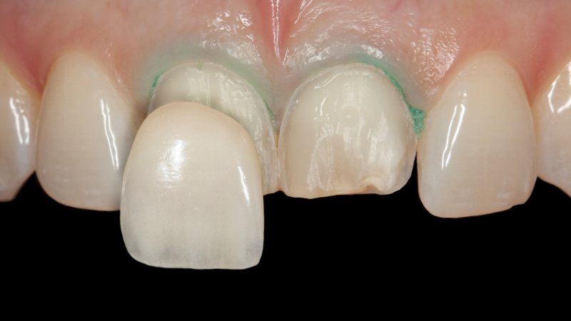 an up-close view of a veneer being placed over an upper front tooth
