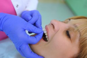 dentist applying veneer to woman's tooth