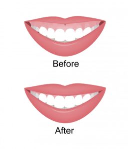 before and after gummy smile illustration