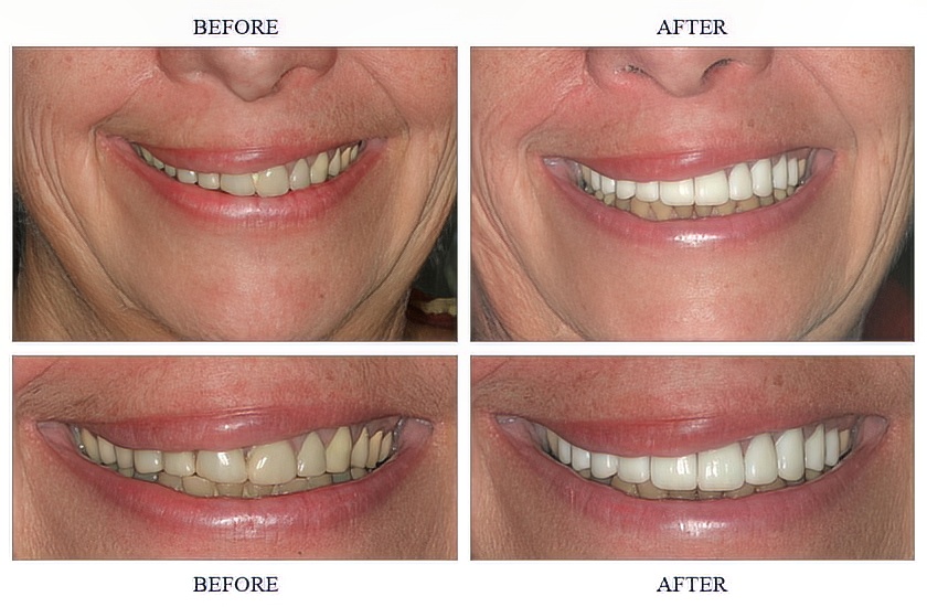 Porcelain (E-Max) Veneers and Crowns