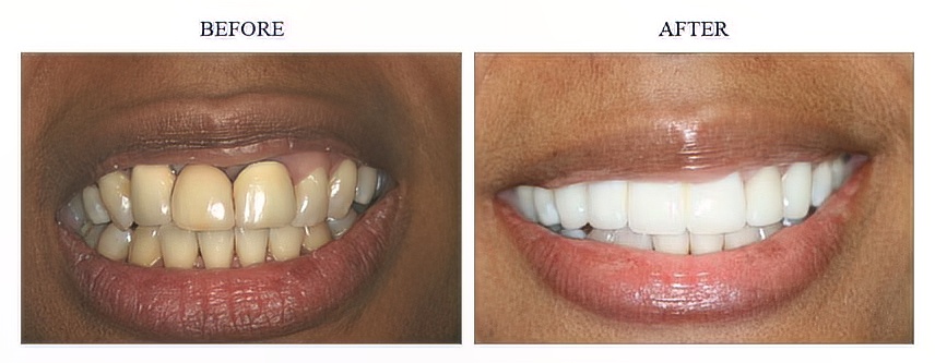 Bleaching, Periodontal and Ceramic Bridge and Crowns