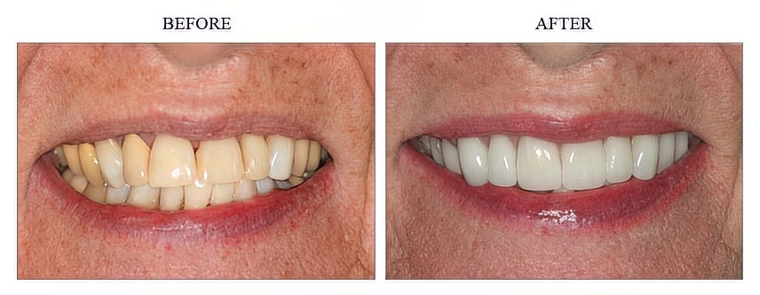 Bleaching and Porcelain Crowns