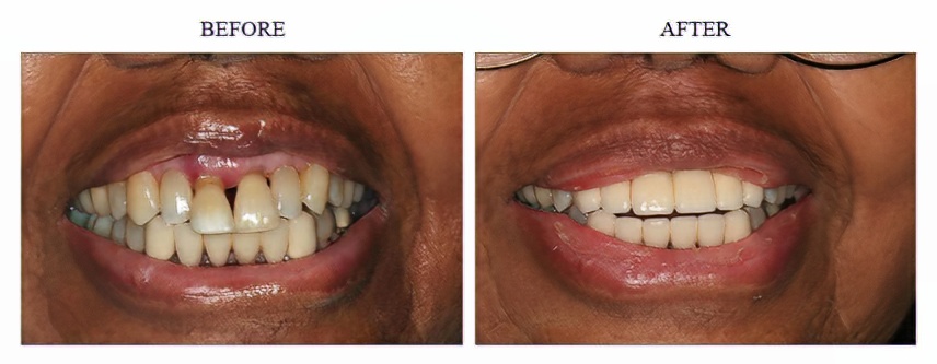 Fixed Bridge Tooth Replacement