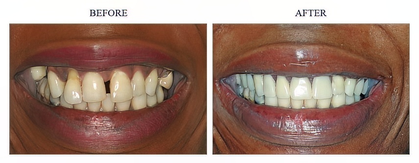 2 Crowns and Precision Attachment (Claspless) Removable Partial Denture